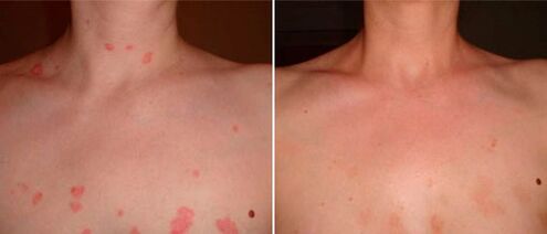 Psoriasis antes y después del tratamiento con crema Keramin