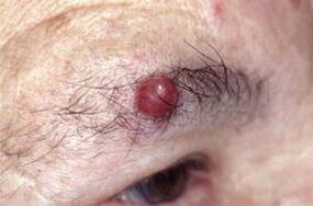 Papiloma en las cejas