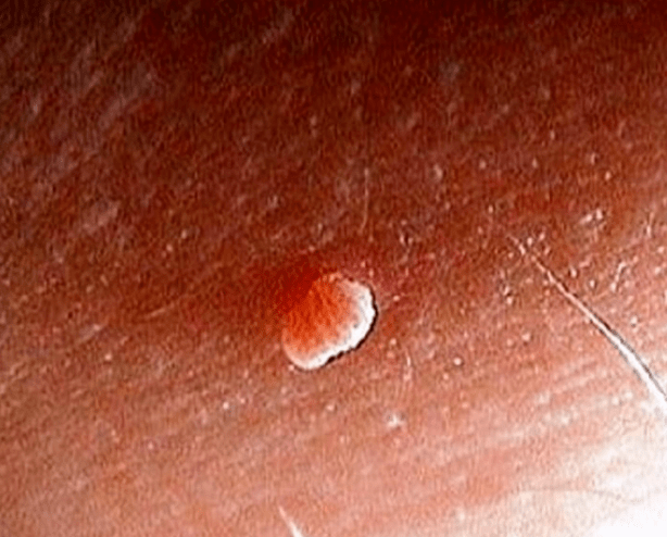 Papiloma en el cuerpo