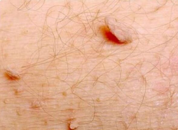 Papilomas afilados en el cuerpo humano