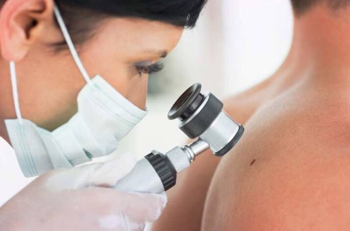 El médico examina el papiloma