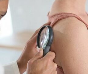 Cómo determinar el virus del papiloma humano
