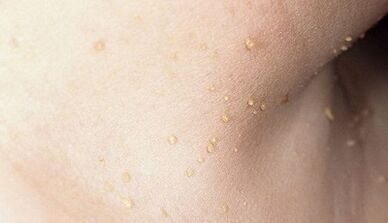 riesgo de desarrollar papilomatosis en el cuello