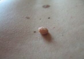 El papiloma es un crecimiento en la superficie de la piel.