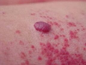 Manchas rojas alrededor del papiloma.