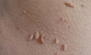 Papilomas filiformes