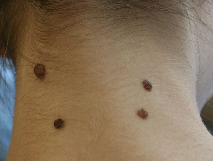 ¿Cómo se ven los papilomas en el cuello