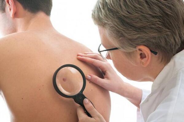 El médico examina el papiloma en la espalda.