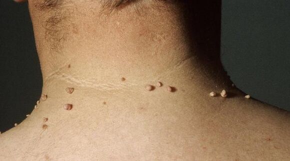 papiloma filiforme en el cuello